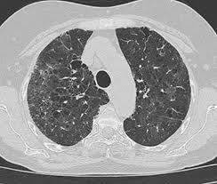 Linee guida internazionali per la valutazione radiologica dei noduli polmonari